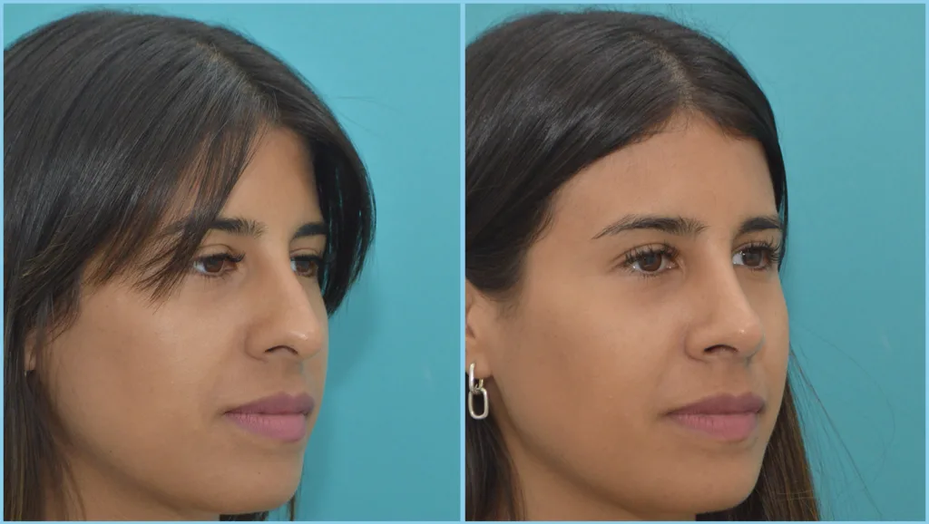 Resultado alejado de rinoplastia antes y después, caso 04, Dres. Moina