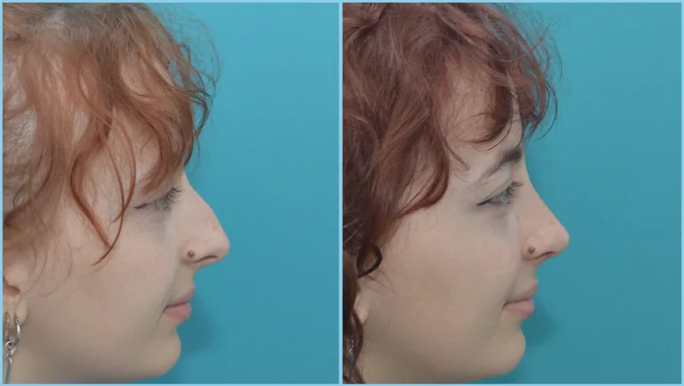 Rinoplastia ultrasónica en Buenos Aires – resultado clínico Dres. Moina