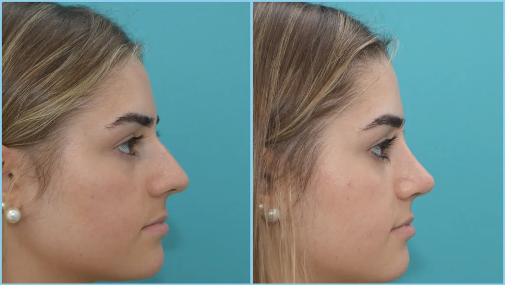 Resultado alejado de rinoplastia antes y después, caso 02, Dres. Moina