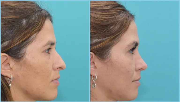 Rinoplastia realizada por Doctores Moina, antes y después