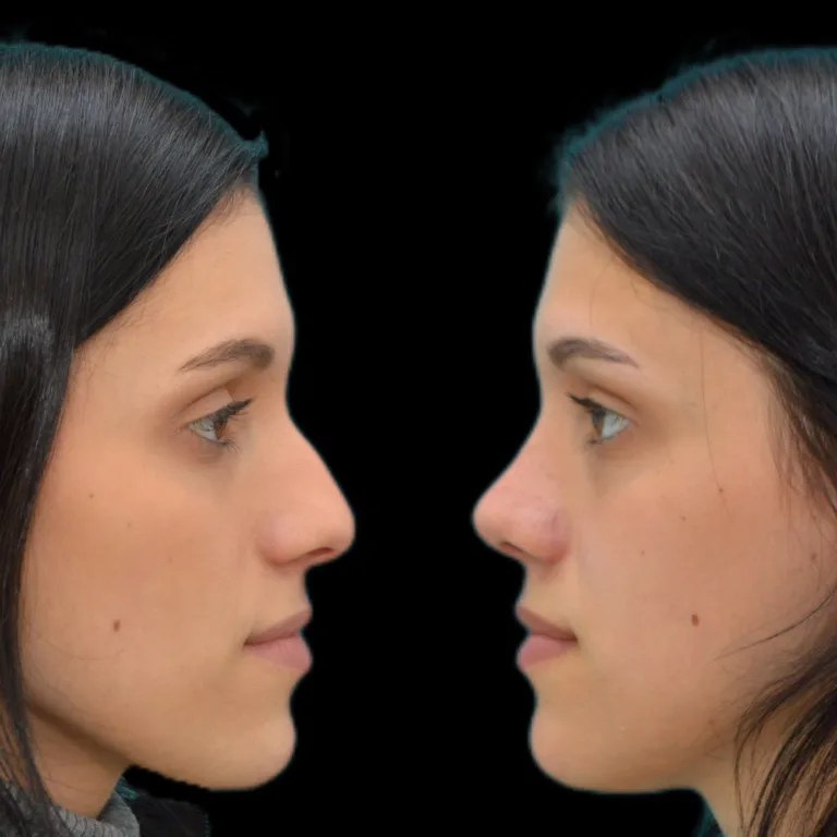 Resultado de rinoplastia estética – caso clínico antes y después Dres. Moina