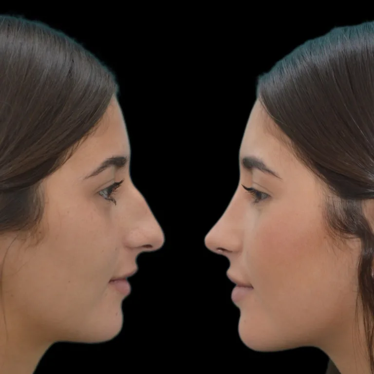 Resultado de rinoplastia estética personalizada – Dres. Moina