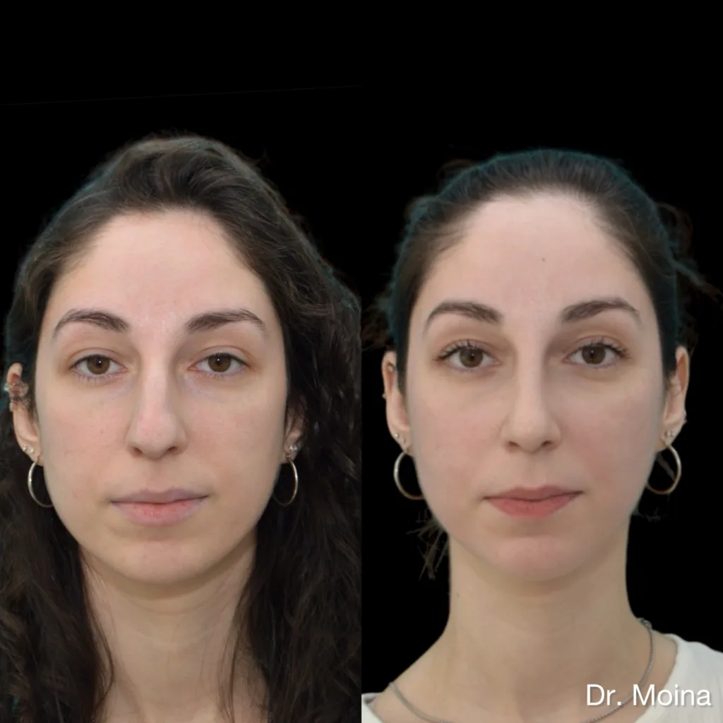 Resultado alejado de rinoplastia antes y después, caso 07, Dres. Moina