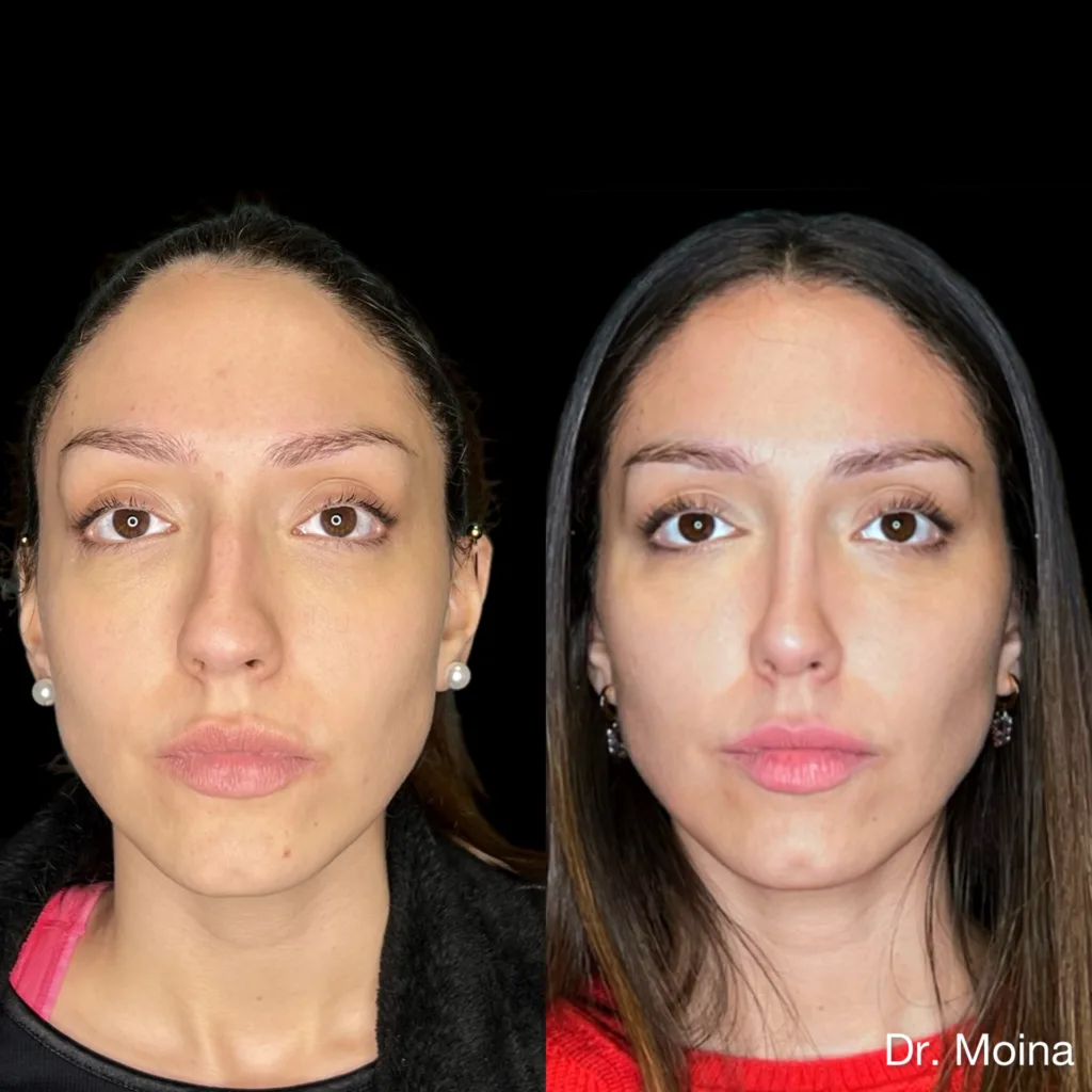 Resultado alejado de rinoplastia antes y después, caso 08, Dres. Moina