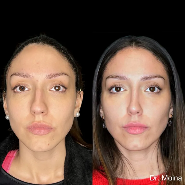 Resultado alejado de rinoplastia, caso 3345 imagen A