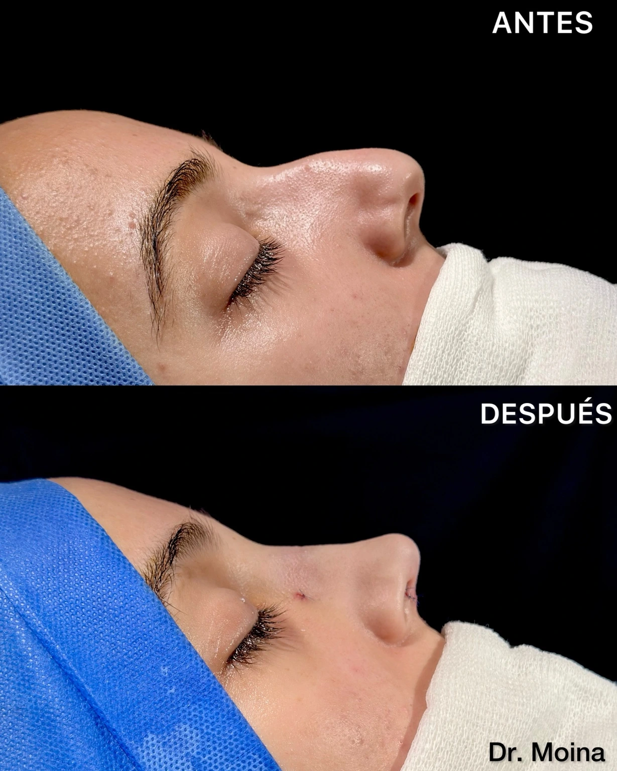 Rinoplastia: comparación antes y después inmediato en vista lateral del caso 0006, Dres. Moina.