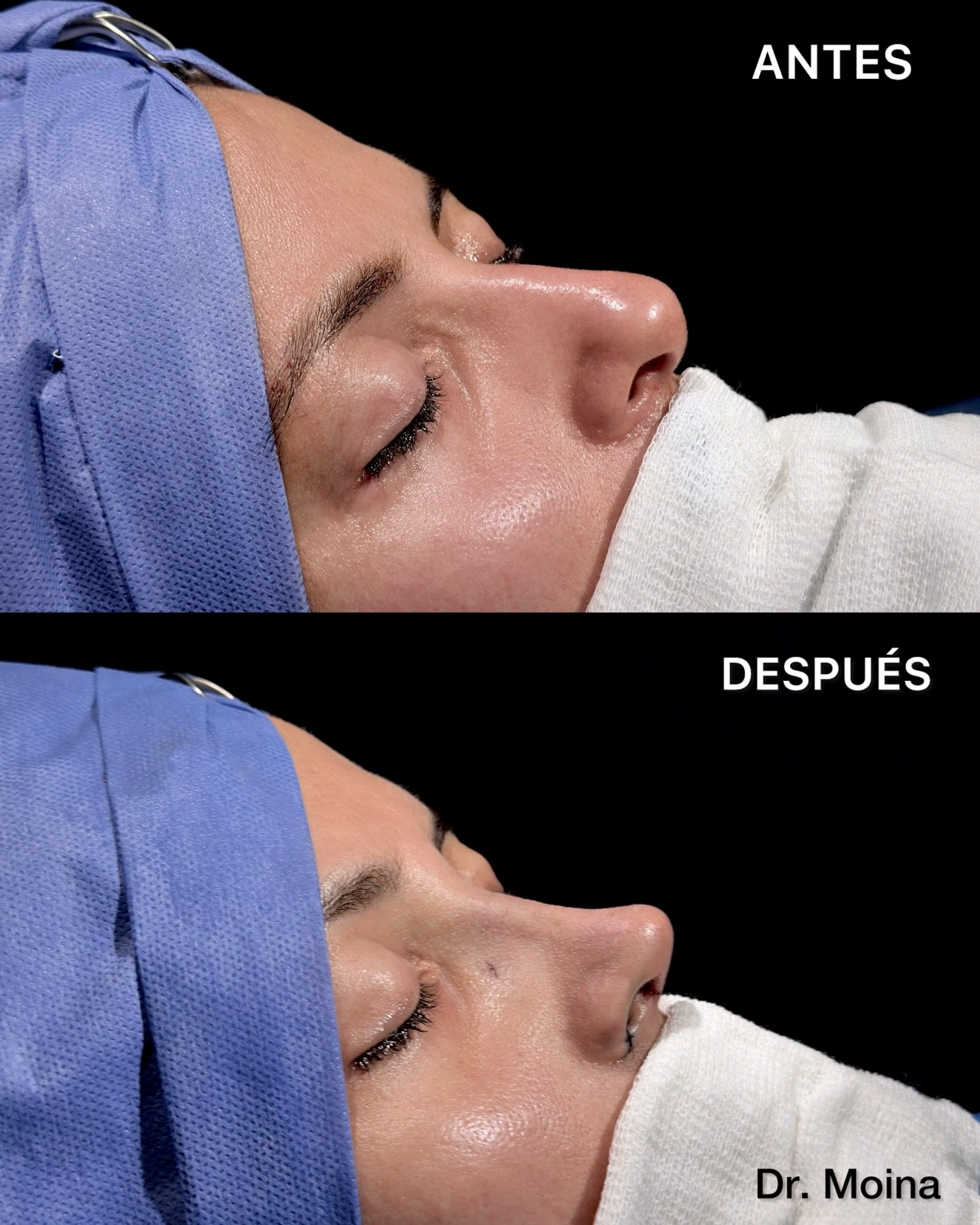 Comparación en vista oblicua: antes arriba y resultado inmediato abajo de rinoplastia ultrasónica funcional en una mujer con piel intermedia.