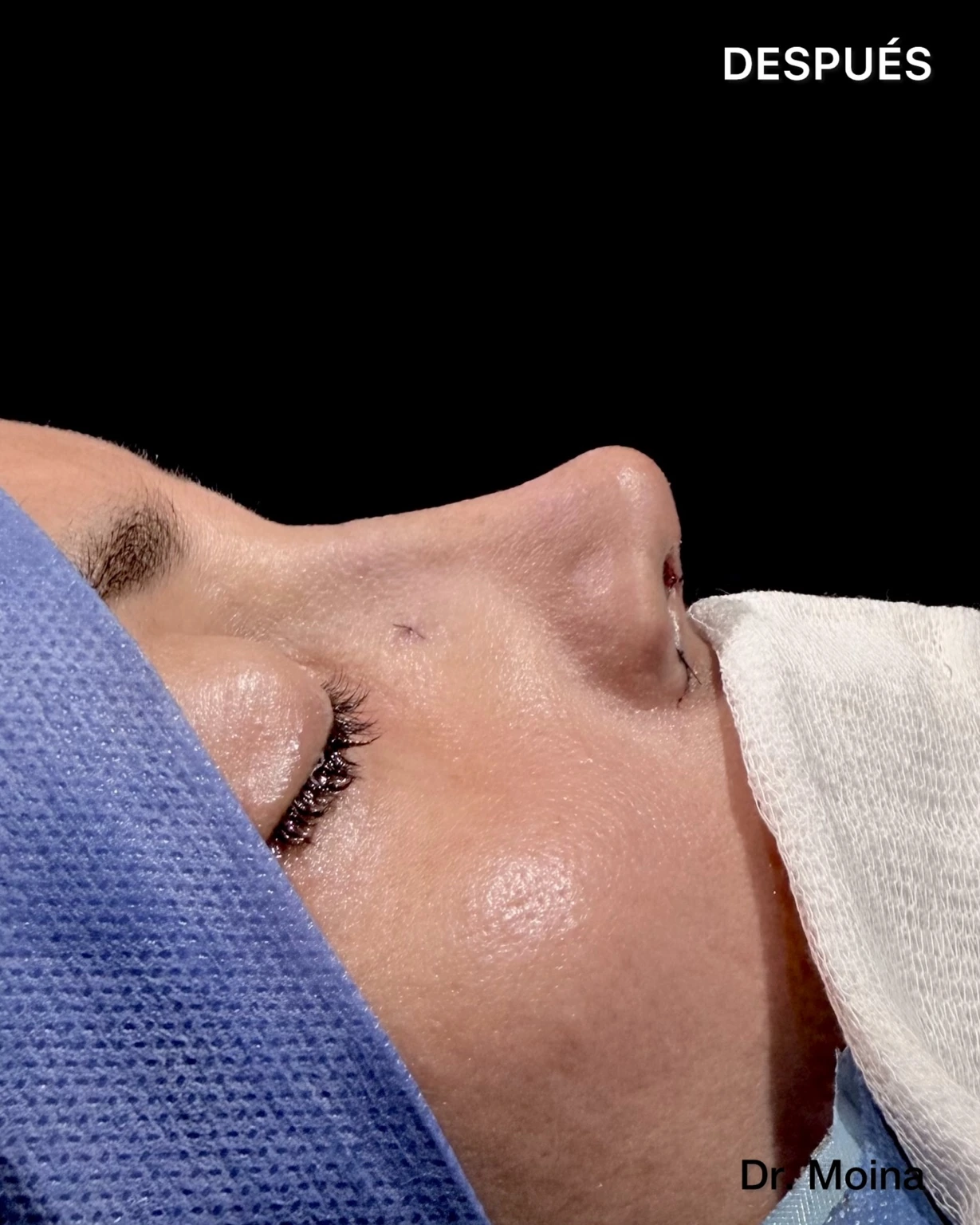 Perfil de una mujer al finalizar una rinoplastia ultrasónica funcional; fotografía del resultado inmediato.