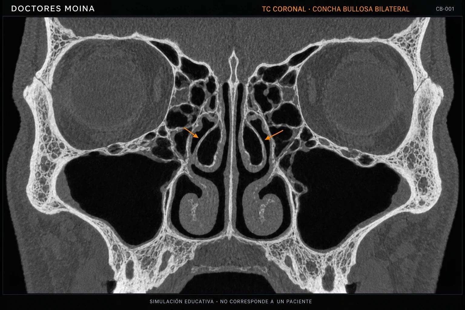 Simulación educativa original de TC coronal con concha bullosa bilateral en ambos cornetes medios, marcadas mediante flechas.