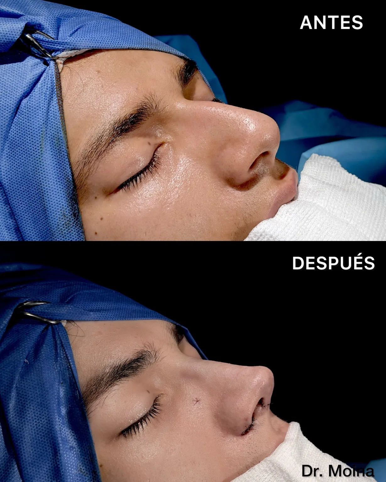 Resultado inmediato de rinoplastia en paciente con piel gruesa y giba nasal, vista oblicua - Dr. Moina