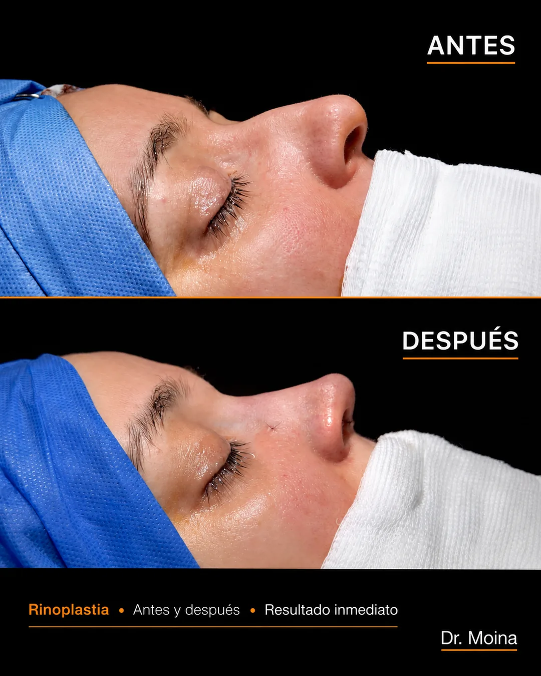 Rinoplastia antes y después en vista de perfil, preoperatorio y resultado inmediato - Dr. Moina