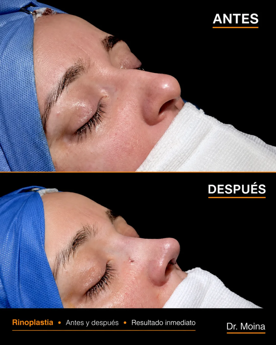 Pre y post de rinoplastia en perfil nasal, antes y después con resultado inmediato - Dr. Moina
