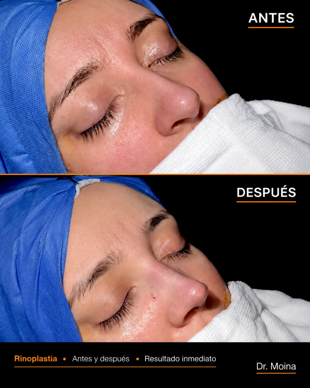 Rinoplastia antes y después en vista oblicua, preoperatorio y resultado postoperatorio inmediato - Dr. Moina