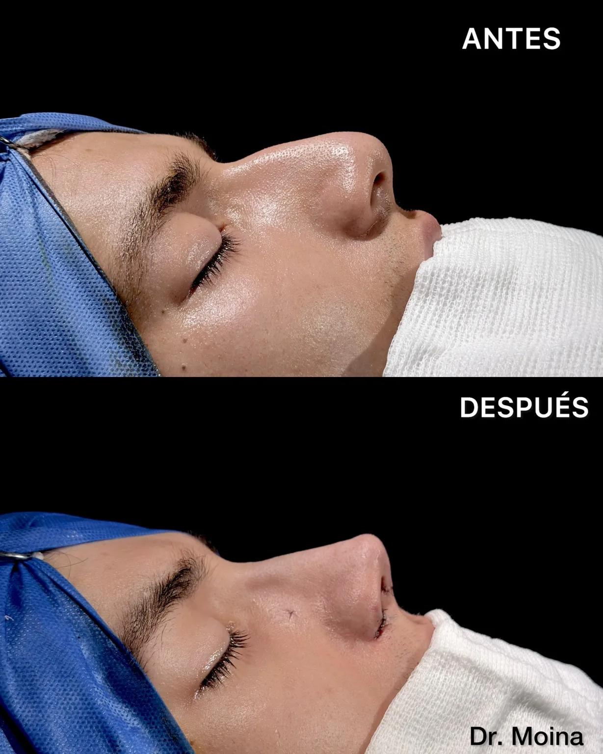 Rinoplastia antes y después inmediato en paciente con piel gruesa, giba nasal y punta ptósica, vista de perfil - Dr. Moina