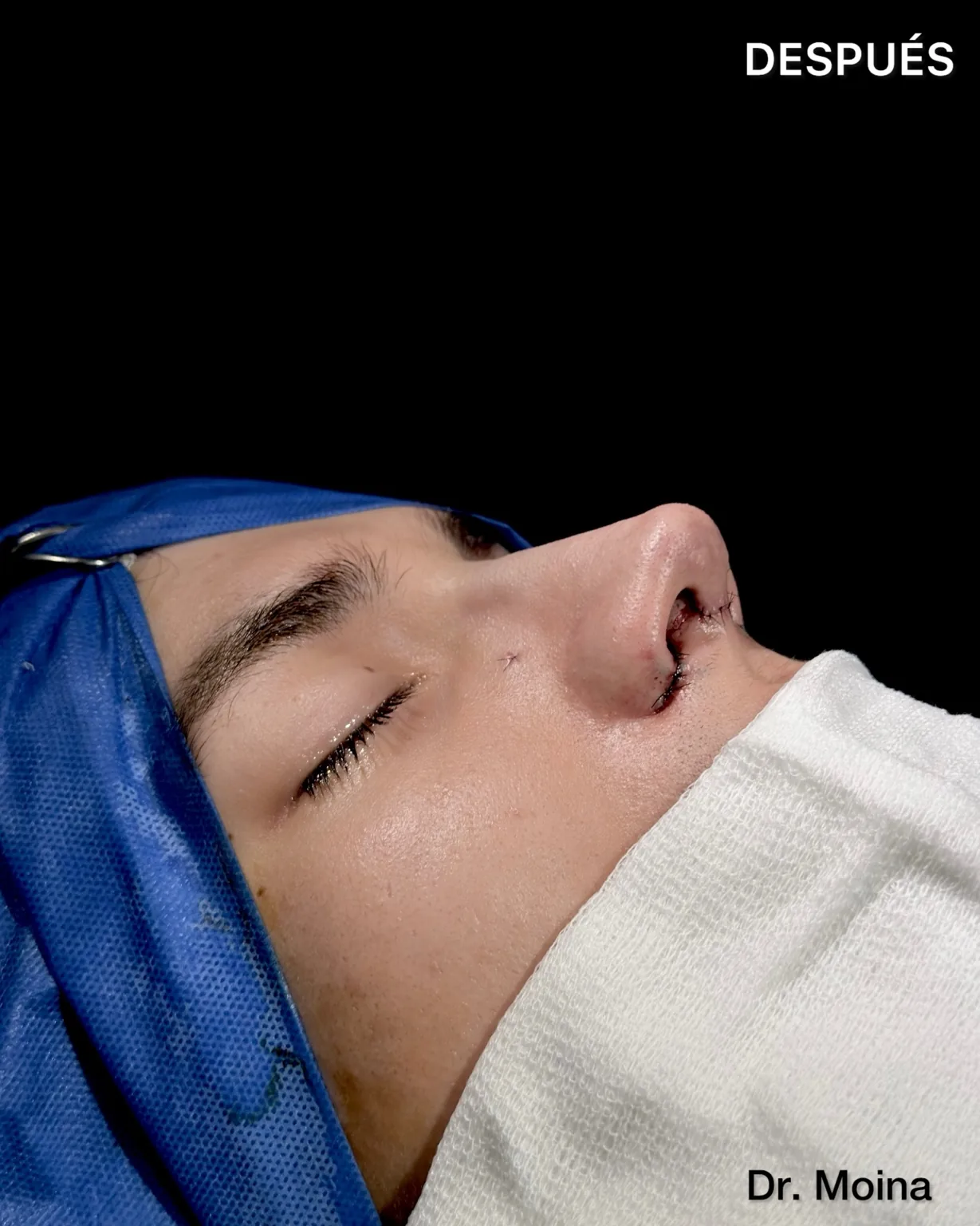 Resultado inmediato de rinoplastia en paciente de piel gruesa, vista lateral con perfil natural - Dr. Moina