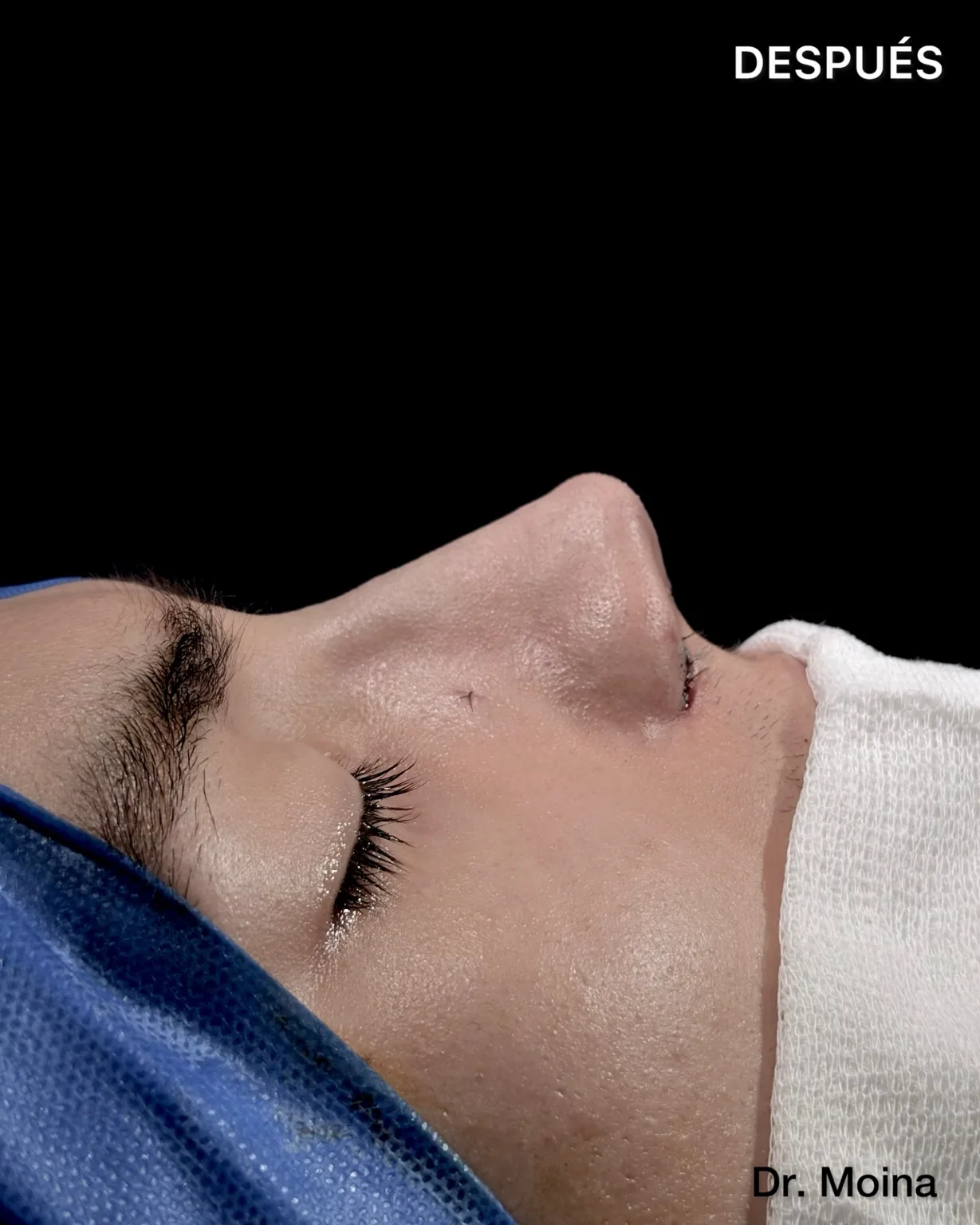 Resultado postoperatorio inmediato de rinoplastia en piel gruesa, perfil nasal - Dr. Moina