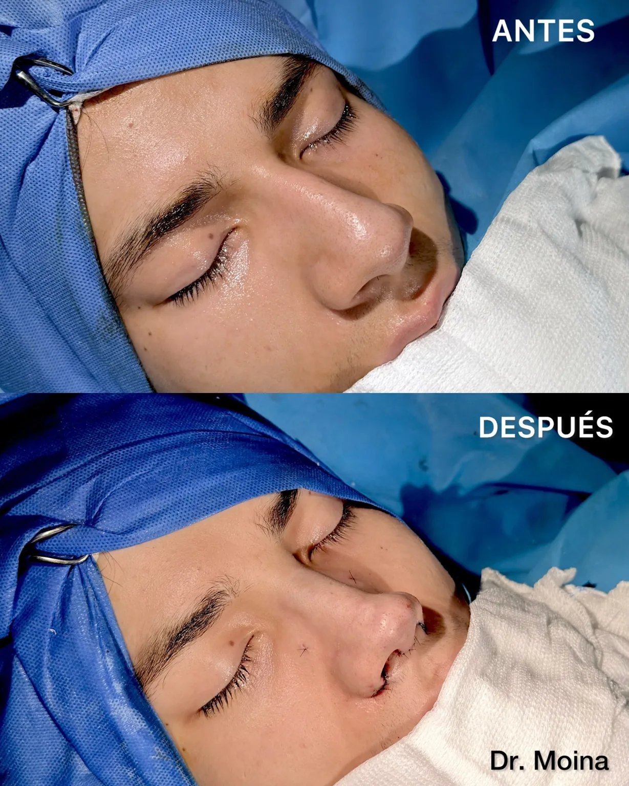 Rinoplastia étnica antes y después inmediato en paciente con piel gruesa, resultado natural - Dr. Moina