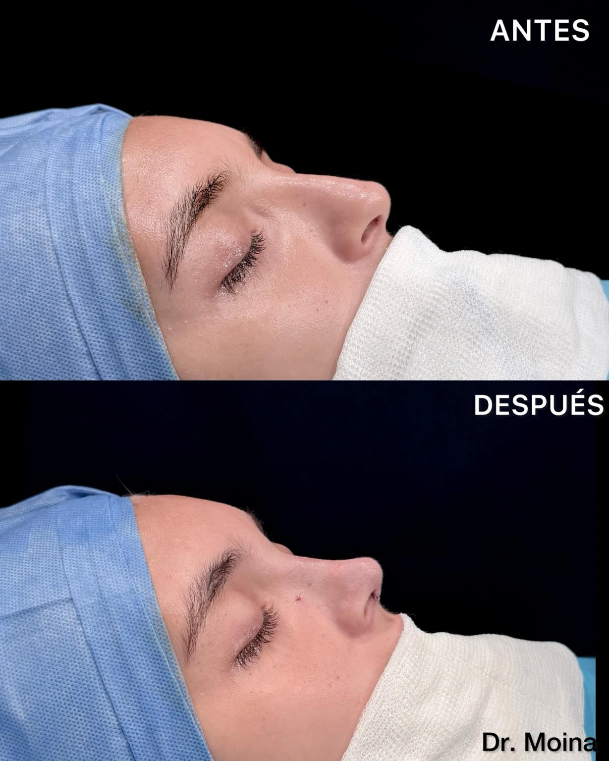 Rinoplastia antes y después, resultado inmediato, perfil lateral, segunda vista, caso 0005 de los Dres. Moina