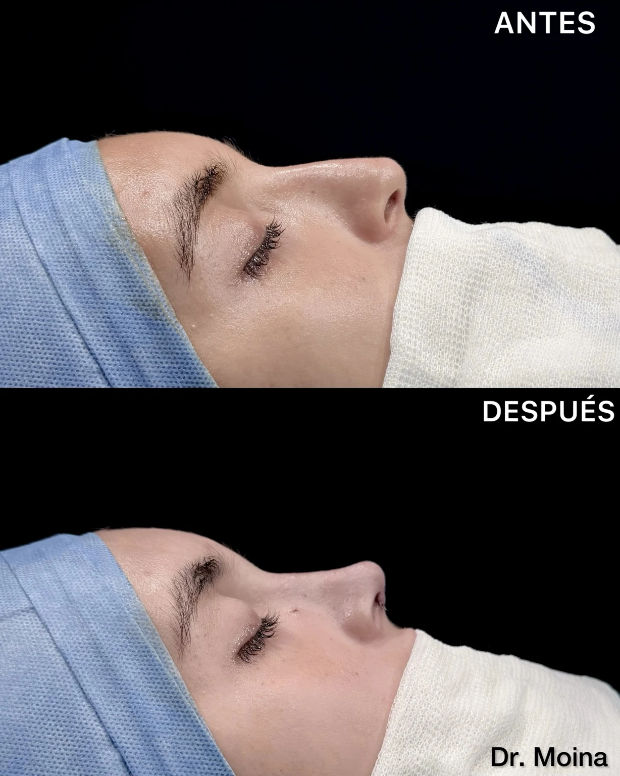 Comparación fotográfica antes y después de rinoplastia, resultado posoperatorio inmediato, perfil lateral; caso 0005 de los Dres. Moina