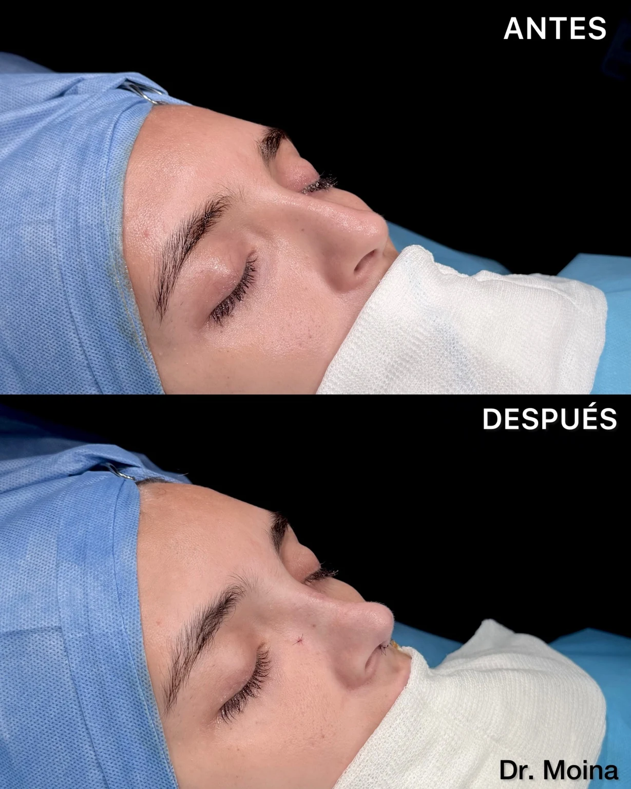 Rinoplastia antes y después, resultado inmediato, vista oblicua, caso 0005 de los Dres. Moina