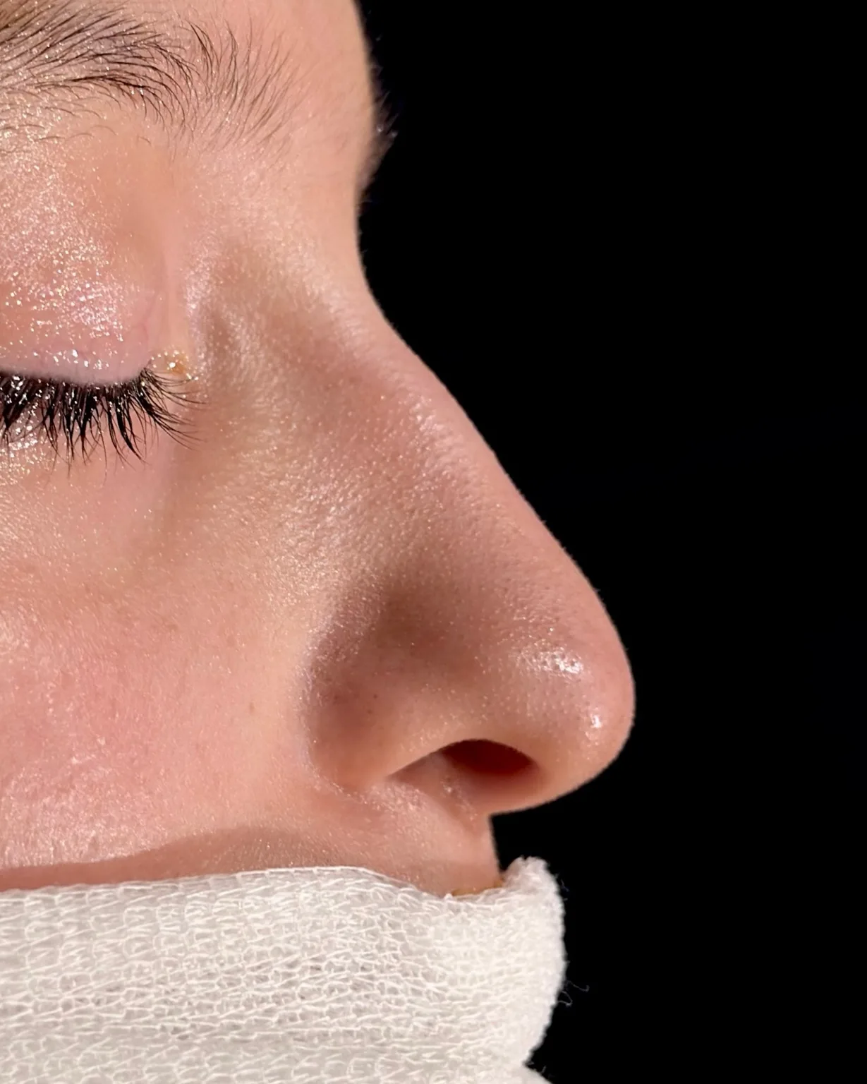 Perfil nasal preoperatorio con giba, detalle del caso 0008