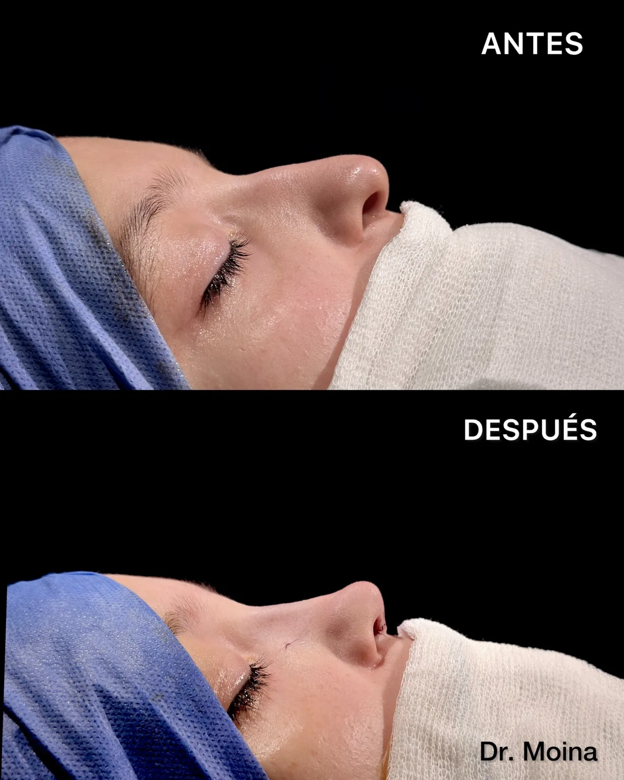 Resultado clínico real de rinoplastia: antes y postoperatorio inmediato de perfil, caso 0008
