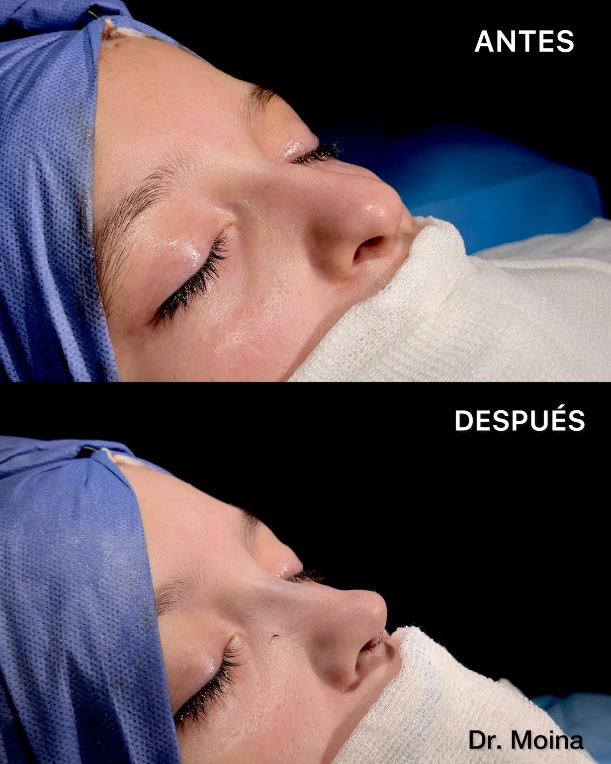 Rinoplastia antes y después: vista oblicua, caso 0008