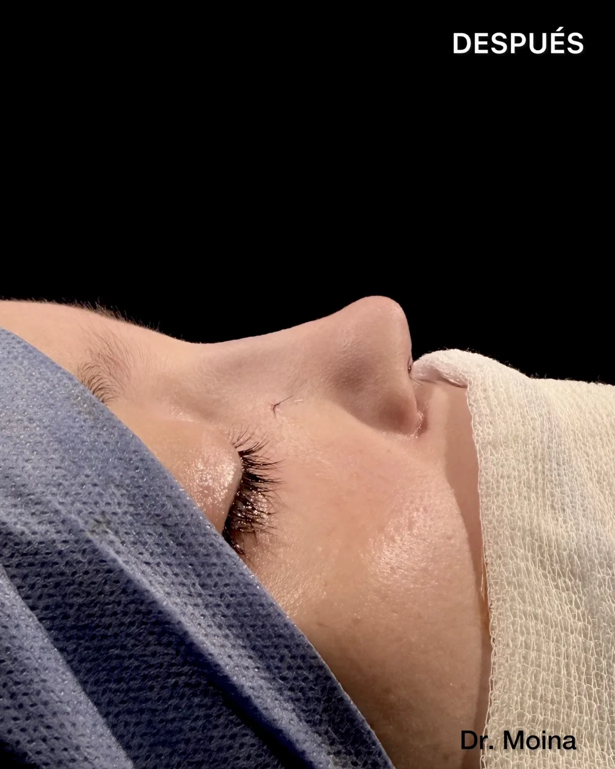 Perfil nasal postoperatorio inmediato, detalle del caso 0008
