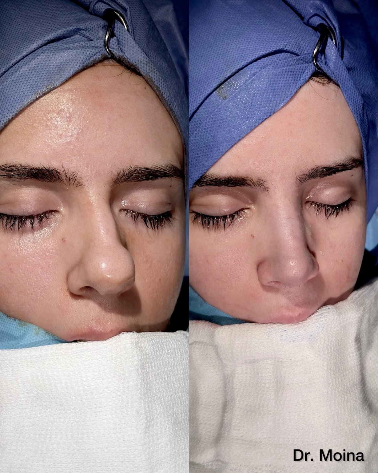 Comparación de rinoplastia antes y después inmediato en paciente con punta nasal bulbosa.